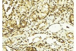 ABIN6267569 at 1/100 staining Human breast cancer tissue by IHC-P. (PRKDC antibody  (pThr2647))