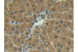Detection of MMP13 in Human Liver Tissue using Polyclonal Antibody to Matrix Metalloproteinase 13 (MMP13) (MMP13 antibody  (AA 103-290))