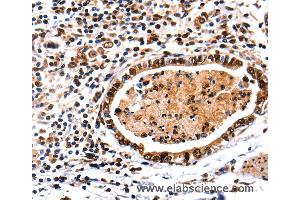 Immunohistochemistry of Human stomach cancer using DNMT3A Polyclonal Antibody at dilution of 1:65 (DNMT3A antibody)