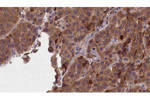 ABIN6277234 at 1/100 staining Human liver cancer tissue by IHC-P. (GNAO1 antibody  (Internal Region))
