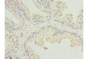 Immunohistochemistry of paraffin-embedded human prostate cancer using ABIN7158931 at dilution of 1:100 (MR1 antibody  (AA 20-260))