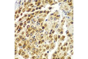 Immunohistochemistry of paraffin-embedded human liver cancer using SND1 antibody. (SND1 antibody)