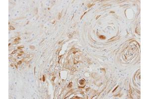 IHC-P Image Immunohistochemical analysis of paraffin-embedded Ca922 xenograft, using BCAT2, antibody at 1:500 dilution. (BCAT2 antibody  (Center))