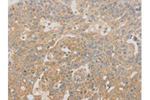 The image on the left is immunohistochemistry of paraffin-embedded Human breast cancer tissue using ABIN7130971(SCAP Antibody) at dilution 1/20, on the right is treated with fusion protein. (SREBF chaperone antibody)