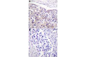 Immunohistochemical staining (Formalin-fixed paraffin-embedded sections) of human breast cancer tissue with RPS6KA1 (phospho T573) polyclonal antibody  without blocking peptide (A) or preincubated with blocking peptide (B) under 1:50-1:100 dilution. (RPS6KA1 antibody  (pThr573))