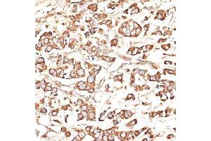Immunohistochemistry of paraffin-embedded human mammary cancer using KIR3DS1 antibody. (KIR3DS1 antibody  (AA 80-340))