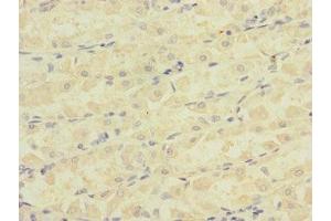 Immunohistochemistry of paraffin-embedded human gastric cancer using ABIN7145065 at dilution of 1:100 (Attractin antibody  (AA 84-350))