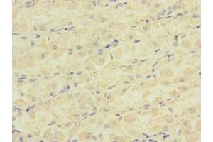 Immunohistochemistry of paraffin-embedded human gastric cancer using ABIN7145065 at dilution of 1:100 (Attractin antibody  (AA 84-350))