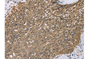 The image on the left is immunohistochemistry of paraffin-embedded Human cervical cancer tissue using ABIN7130557(PCP4 Antibody) at dilution 1/50, on the right is treated with fusion protein. (PCP4 antibody)