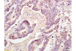 Formalin-fixed and paraffin embedded human colon carcinoma labeled with Rabbit Anti Adiponectin Polyclonal Antibody, Unconjugated (ABIN669051) at 1:200 followed by conjugation to the secondary antibody and DAB staining (ADIPOQ antibody  (AA 151-244))