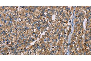 Immunohistochemistry of paraffin-embedded Human esophagus cancer using BSG Polyclonal Antibody at dilution of 1:60 (CD147 antibody)
