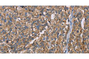 Immunohistochemistry of paraffin-embedded Human esophagus cancer using BSG Polyclonal Antibody at dilution of 1:60 (CD147 antibody)