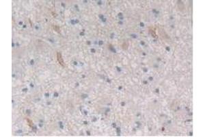 IHC-P analysis of Human Glioma Tissue, with DAB staining. (CTRB1 antibody  (AA 34-261))