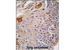 Formalin-fixed and paraffin-embedded human lung carcinoma reacted with RMND5B antibody (C-term), which was peroxidase-conjugated to the secondary antibody, followed by DAB staining.