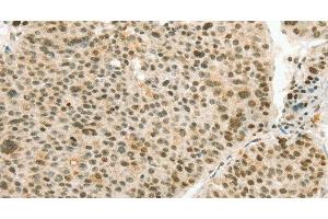 Immunohistochemistry of paraffin-embedded Human liver cancer using ANGPT4 Polyclonal Antibody at dilution of 1:70 (Angiopoietin 4 antibody)