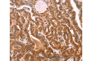 Immunohistochemistry of Human lung cancer using PROS1 Polyclonal Antibody at dilution of 1:40 (PROS1 antibody)