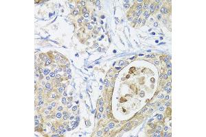 Immunohistochemistry of paraffin-embedded human prostate cancer using GSTA2 antibody at dilution of 1:100 (x40 lens).