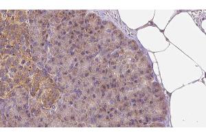ABIN6273260 at 1/100 staining Human pancreas cancer tissue by IHC-P. (LAPTM4B antibody  (Internal Region))