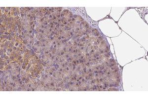 ABIN6273260 at 1/100 staining Human pancreas cancer tissue by IHC-P.
