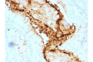 Formalin-fixed, paraffin-embedded human Colon Carcinoma stained with Lewis Y Mouse Monoclonal Antibody (A70-A/A9). (Blood Group Lewis Y antibody)