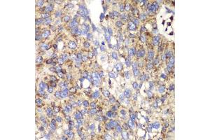 Immunohistochemistry of paraffin-embedded human lung cancer using SPARC antibody (ABIN3022250, ABIN3022251, ABIN1513555 and ABIN6218694) at dilution of 1:100 (40x lens). (SPARC antibody  (AA 18-303))