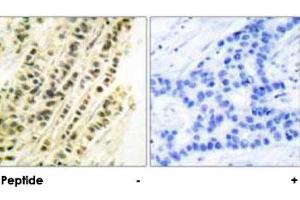 Immunohistochemical analysis of paraffin-embedded human breast carcinoma tissue using SRF polyclonal antibody . (SRF antibody)