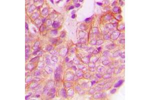 Immunohistochemical analysis of FRK staining in human breast cancer formalin fixed paraffin embedded tissue section. (FRK antibody  (Center))