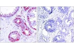 Immunohistochemistry analysis of paraffin-embedded human breast carcinoma, using c-Jun (Phospho-Ser243) Antibody. (C-JUN antibody  (pSer243))