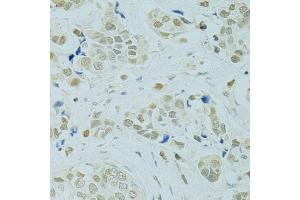 Immunohistochemistry of paraffin-embedded human breast cancer using RCC1 antibody (ABIN5973761) at dilution of 1/100 (40x lens). (RCC1 antibody)