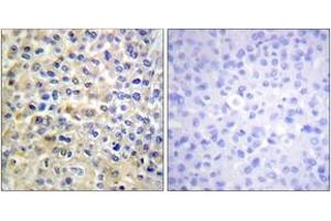 Immunohistochemistry analysis of paraffin-embedded human breast carcinoma tissue, using EGFR (Ab-678) Antibody. (EGFR antibody  (AA 651-700))