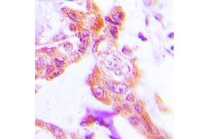 Immunohistochemical analysis of GUCY1B2 staining in human lung cancer formalin fixed paraffin embedded tissue section.