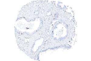 Prostatic adenocarcinoma Gleason 336 with strong MCM3 positivity of few tumor cells (MCM3 antibody)