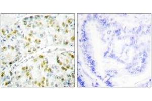 Immunohistochemistry analysis of paraffin-embedded human lung carcinoma tissue, using Ataxin 1 (Ab-776) Antibody. (Ataxin 1 antibody  (AA 742-791))