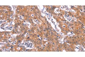 Immunohistochemistry of paraffin-embedded Human gastic cancer using CD269 Polyclonal Antibody at dilution of 1:30 (BCMA antibody)