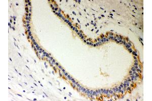 Anti- Unrip Picoband antibody, IHC(P) IHC(P): Human Mammary Cancer Tissue (STRAP antibody  (N-Term))