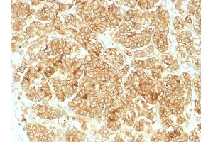 Formalin-fixed, paraffin-embedded human Renal Cell Carcinoma stained with EpCAM Rabbit Polyclonal Antibody. (EpCAM antibody)