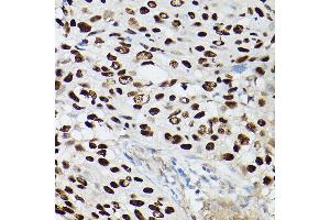 Immunohistochemistry of paraffin-embedded human lung squamous carcinoma tissue using p63 Rabbit mAb (ABIN7271099) at dilution of 1:100 (40x lens). (p63 antibody)