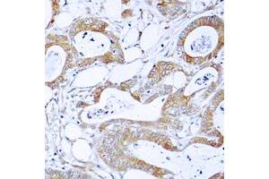 Immunohistochemical analysis of BCR staining in human colon cancer formalin fixed paraffin embedded tissue section. (BCR antibody  (N-Term))
