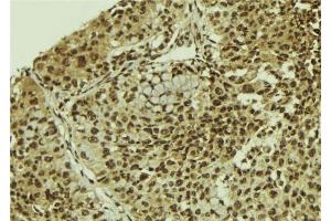 ABIN6278743 at 1/100 staining Human breast cancer tissue by IHC-P. (SART3 antibody  (C-Term))