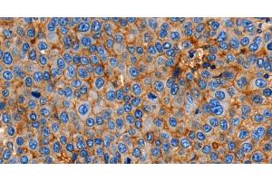 Immunohistochemistry of paraffin-embedded Human esophagus cancer using Claudin 1 Polyclonal Antibody at dilution of 1:150 (Claudin 1 antibody)