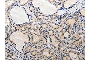 The image on the left is immunohistochemistry of paraffin-embedded Human thyroid cancer tissue using ABIN7189663(ADAMTS6 Antibody) at dilution 1/20, on the right is treated with synthetic peptide. (ADAMTS6 antibody)