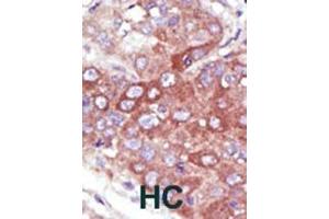 Formalin-fixed and paraffin-embedded human cancer tissue reacted with the primary antibody, which was peroxidase-conjugated to the secondary antibody, followed by DAB staining. (UBE2D1 antibody  (C-Term))