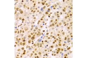 Immunohistochemistry of paraffin-embedded human liver cancer using DKC1 Antibody (ABIN5970956) at dilution of 1/100 (40x lens). (DKC1 antibody)