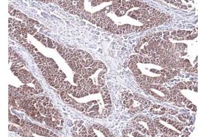 IHC-P Image Immunohistochemical analysis of paraffin-embedded Lung Ad Cancer PC14 xenograft, using PCCB, antibody at 1:100 dilution. (PCCB antibody  (Center))