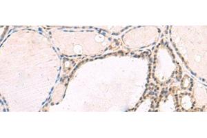 Immunohistochemistry of paraffin-embedded Human thyroid cancer tissue using RNF13 Polyclonal Antibody at dilution of 1:60(x200) (RNF13 antibody)