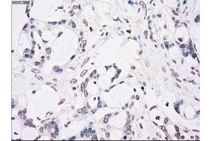 Immunohistochemical staining of paraffin-embedded Adenocarcinoma of colon tissue using anti-CHEK2mouse monoclonal antibody. (CHEK2 antibody)