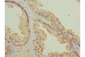 Immunohistochemistry of paraffin-embedded human prostate cancer using ABIN7147501 at dilution of 1:100 (CGGBP1 antibody  (AA 1-167))