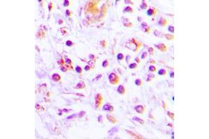 Immunohistochemical analysis of IL-32 staining in human lung cancer formalin fixed paraffin embedded tissue section.