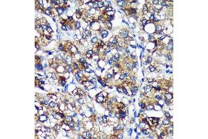 Immunohistochemistry of paraffin-embedded Human liver cancer using PYCR2 Rabbit pAb (ABIN7269766) at dilution of 1:100 (40x lens).