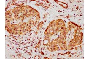 IHC image of ABIN7156000 diluted at 1:500 and staining in paraffin-embedded human pancreatic cancer performed on a Leica BondTM system. (HMGCS1 antibody  (AA 360-520))